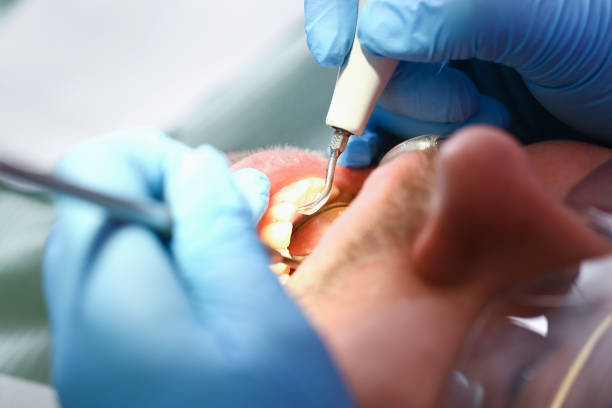 Best Chipped Tooth Repair Near Me  in Harmony, RI