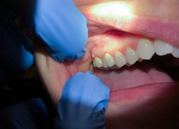 Best Cracked Tooth Emergency Dentist  in Harmony, RI